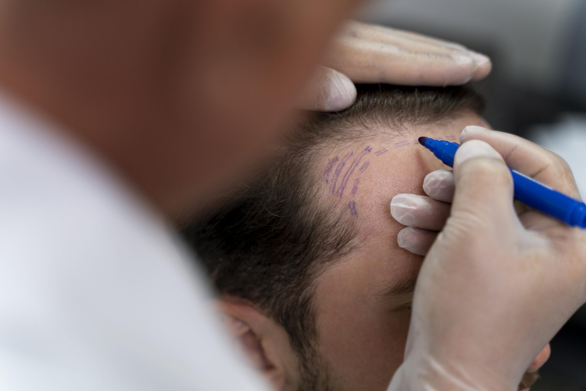 John Cena Hair Transplant
