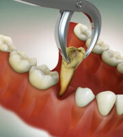 tooth extraction in Cypress