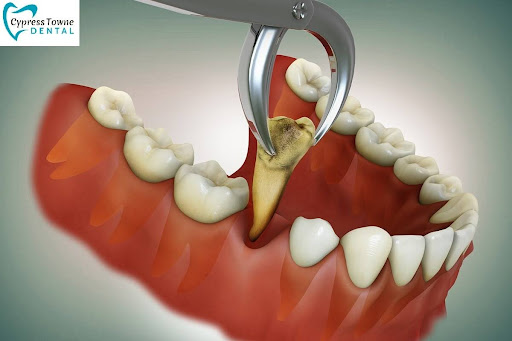 tooth extraction in Cypress