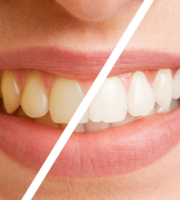 Professional Care for Brown Tooth Stains