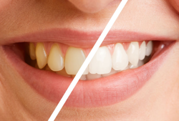 Professional Care for Brown Tooth Stains