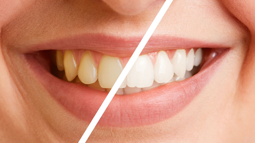 Professional Care for Brown Tooth Stains